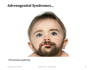 Adrenogenital Syndromes..,
Tuesday, July 30, 2024 Ephraim Zulu - PATHOLOGY 59
Precocious puberty
 