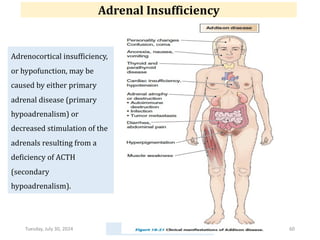 Tuesday, July 30, 2024 Ephraim Zulu - PATHOLOGY 60
Adrenocortical insufficiency,
or hypofunction, may be
caused by either primary
adrenal disease (primary
hypoadrenalism) or
decreased stimulation of the
adrenals resulting from a
deficiency of ACTH
(secondary
hypoadrenalism).
Adrenal Insufficiency
 