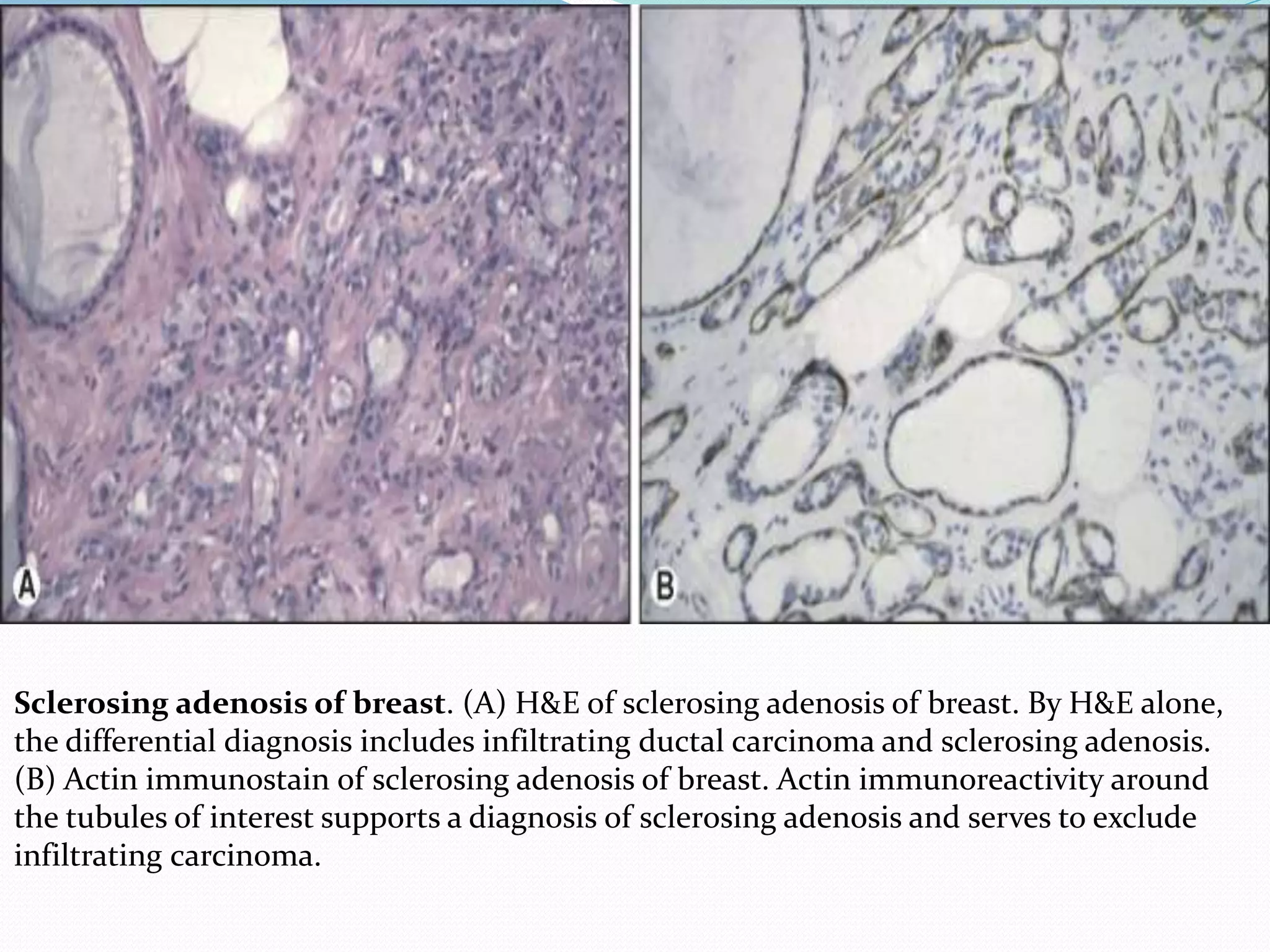 Sclerosing adenosis of breast. (A) H&E of sclerosing adenosis of breast. By H&E alone,
the differential diagnosis includes infiltrating ductal carcinoma and sclerosing adenosis.
(B) Actin immunostain of sclerosing adenosis of breast. Actin immunoreactivity around
the tubules of interest supports a diagnosis of sclerosing adenosis and serves to exclude
infiltrating carcinoma.
 