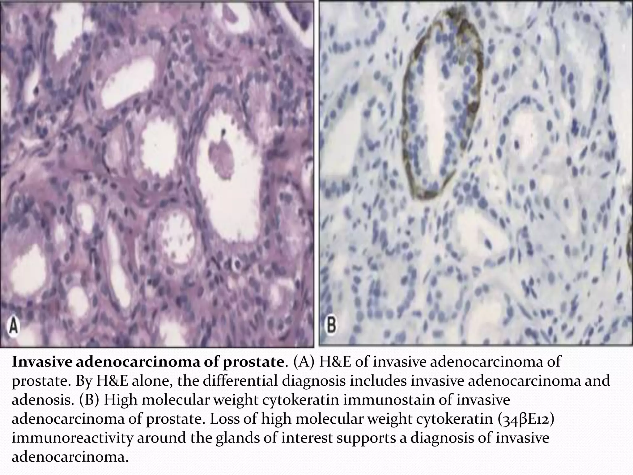 Invasive adenocarcinoma of prostate. (A) H&E of invasive adenocarcinoma of
prostate. By H&E alone, the differential diagnosis includes invasive adenocarcinoma and
adenosis. (B) High molecular weight cytokeratin immunostain of invasive
adenocarcinoma of prostate. Loss of high molecular weight cytokeratin (34βE12)
immunoreactivity around the glands of interest supports a diagnosis of invasive
adenocarcinoma.
 