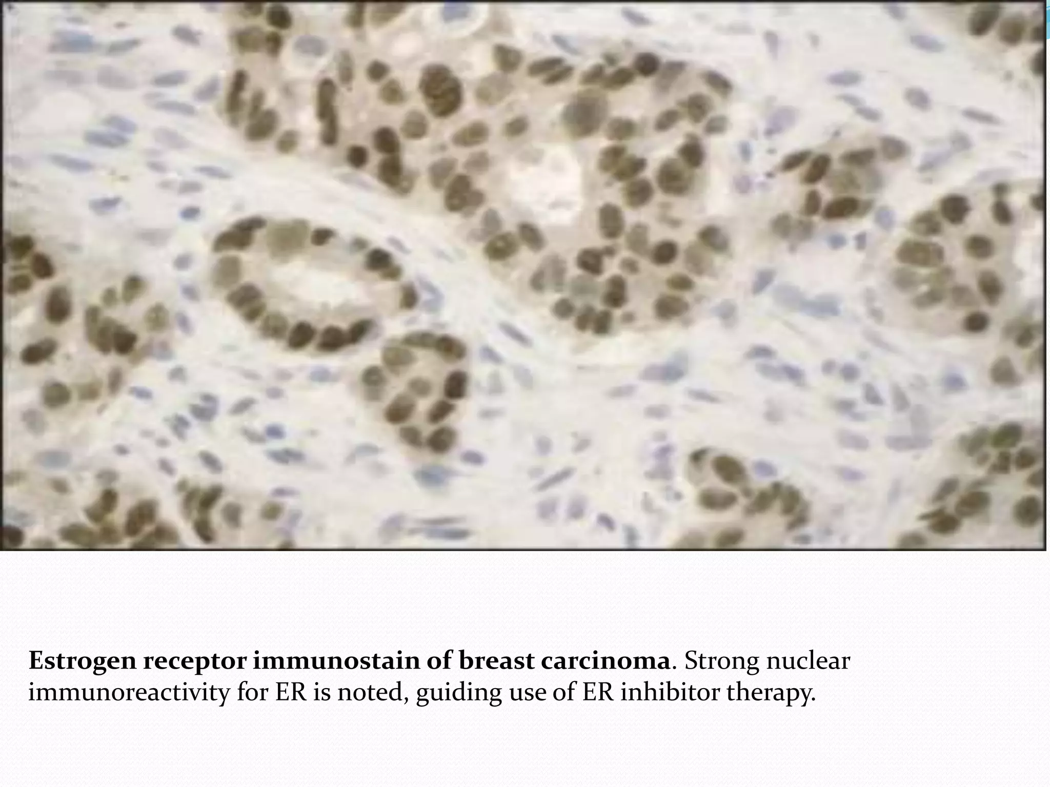Estrogen receptor immunostain of breast carcinoma. Strong nuclear
immunoreactivity for ER is noted, guiding use of ER inhibitor therapy.
 