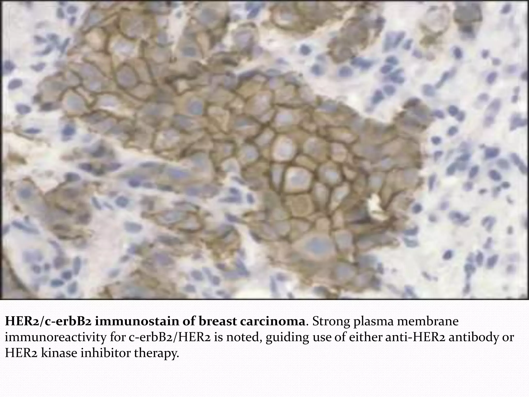 HER2/c-erbB2 immunostain of breast carcinoma. Strong plasma membrane
immunoreactivity for c-erbB2/HER2 is noted, guiding use of either anti-HER2 antibody or
HER2 kinase inhibitor therapy.
 
