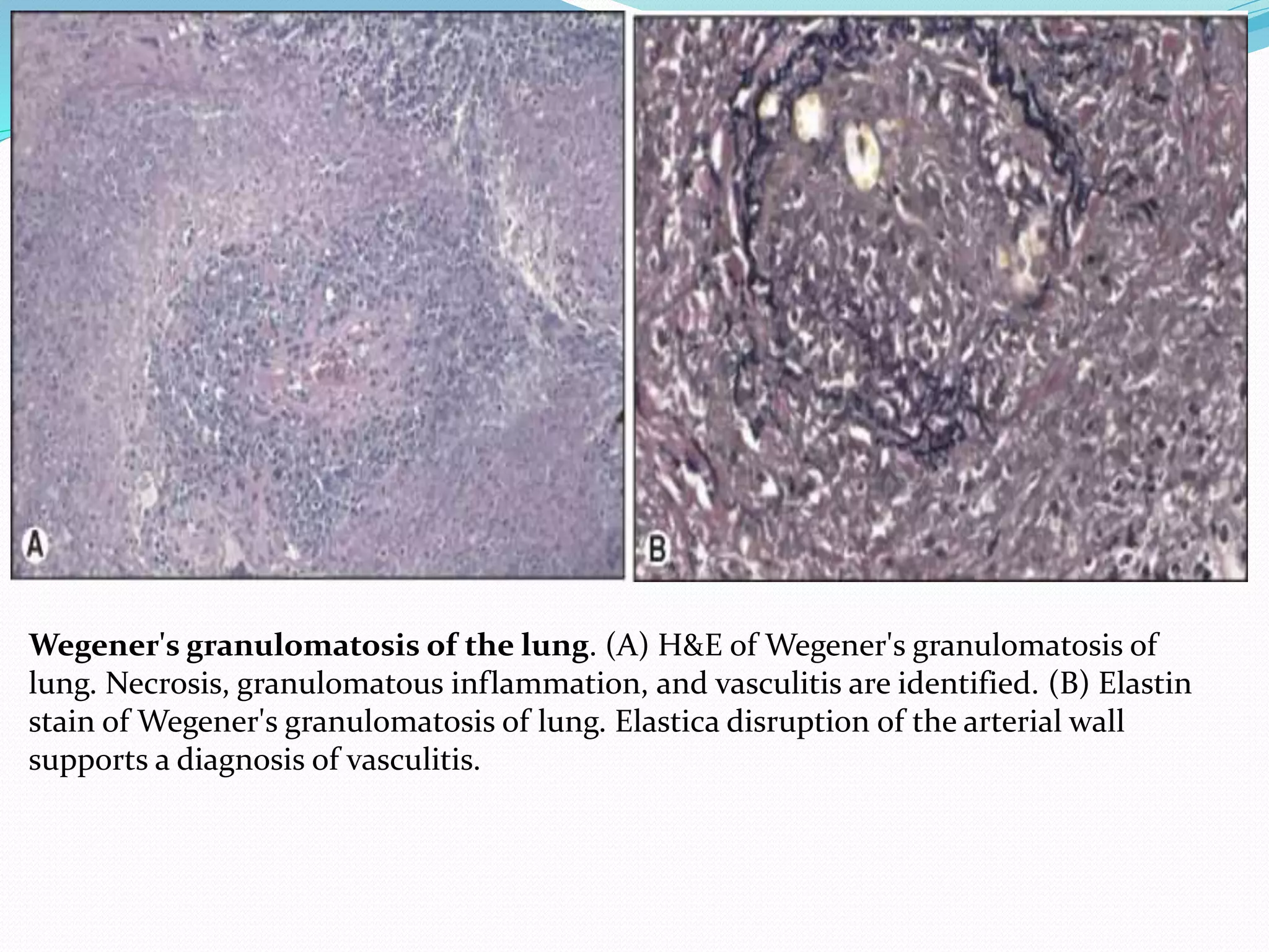 Wegener's granulomatosis of the lung. (A) H&E of Wegener's granulomatosis of
lung. Necrosis, granulomatous inflammation, and vasculitis are identified. (B) Elastin
stain of Wegener's granulomatosis of lung. Elastica disruption of the arterial wall
supports a diagnosis of vasculitis.
 