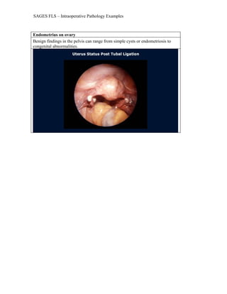 SAGES FLS – Intraoperative Pathology Examples
Endometrius on ovary
Benign findings in the pelvis can range from simple cysts or endometriosis to
congenital abnormalities.
 