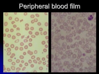 Peripheral blood film
 