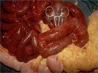 Infarcted bowel -- gross
 