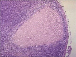 Adrenal infarct -- Micro
 