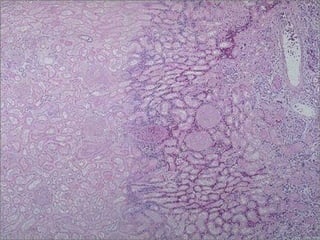 3 stages of coagulative
necrosis (L to R) -- micro
 