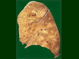 Lung abscesses (liquefactive
necrosis) -- gross
 