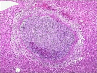 Liver abscess -- micro
 