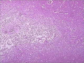 Liquefactive necrosis of brain
-- micro
 
