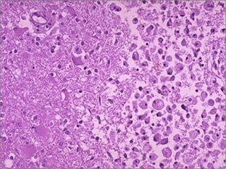 Macrophages cleaning
liquefactive necrosis -- micro
 