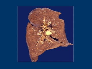 Caseous necrosis -- gross
 