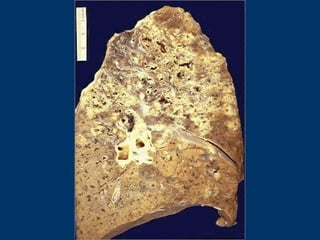 Extensive caseous necrosis
-- gross
 