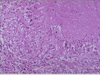 Caseous necrosis -- micro
 