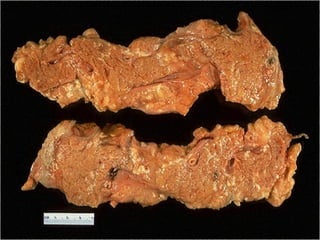 Enzymatic fat necrosis of
pancreas -- gross
 