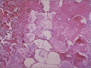 Fat necrosis -- micro
 