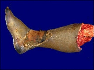 Wet gangrene -- gross
 