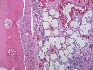 Gangrenous necrosis -- micro
 