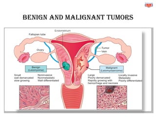Benign and malignant tumors
 