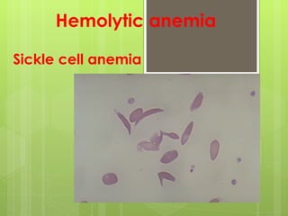 Sickle cell anemia Hemolytic anemia 