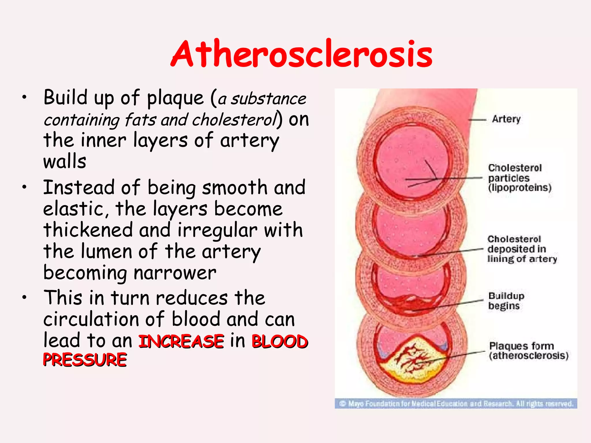 Atherosclerosis Build up of plaque ( a substance containing fats and cholesterol ) on the inner layers of artery walls Instead of being smooth and elastic, the layers become thickened and irregular with the lumen of the artery becoming narrower This in turn reduces the circulation of blood and can lead to an  INCREASE  in  BLOOD PRESSURE 