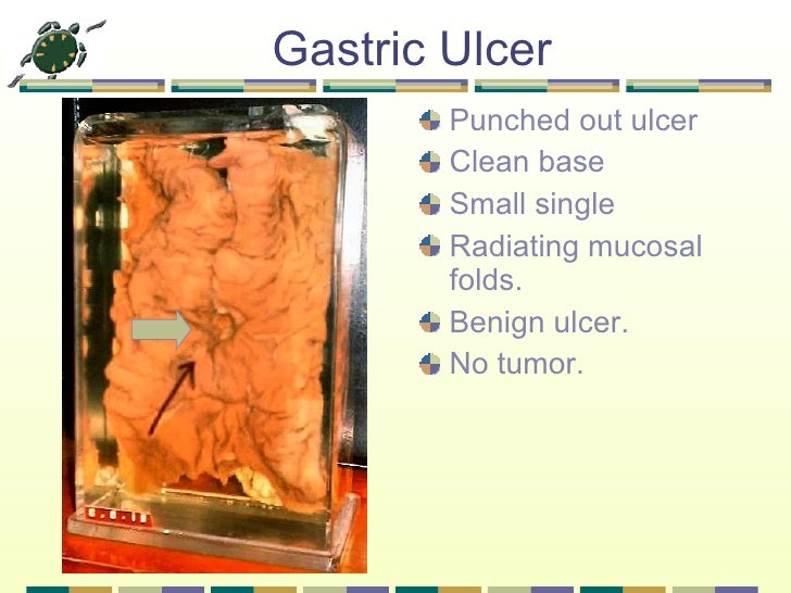 Rohal.peptic ulcer