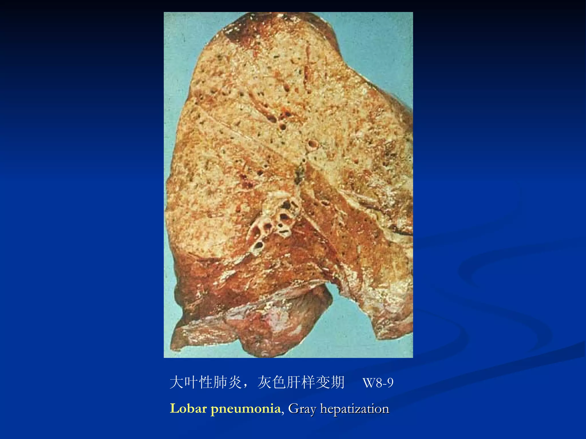大叶性肺炎，灰色肝样变期　 W8-9 Lobar pneumonia ,  Gray hepatization  