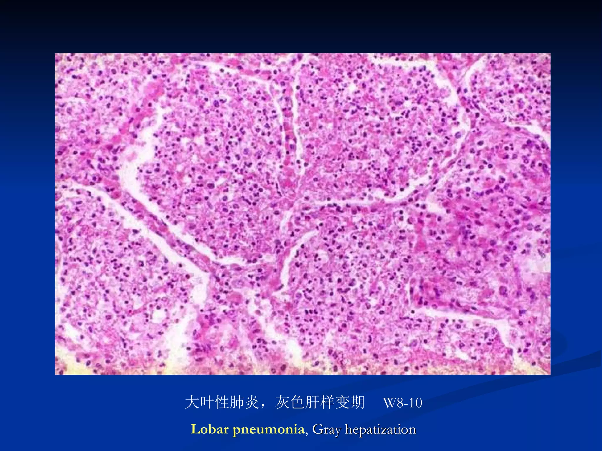 大叶性肺炎，灰色肝样变期　 W8-10 Lobar pneumonia ,  Gray hepatization 