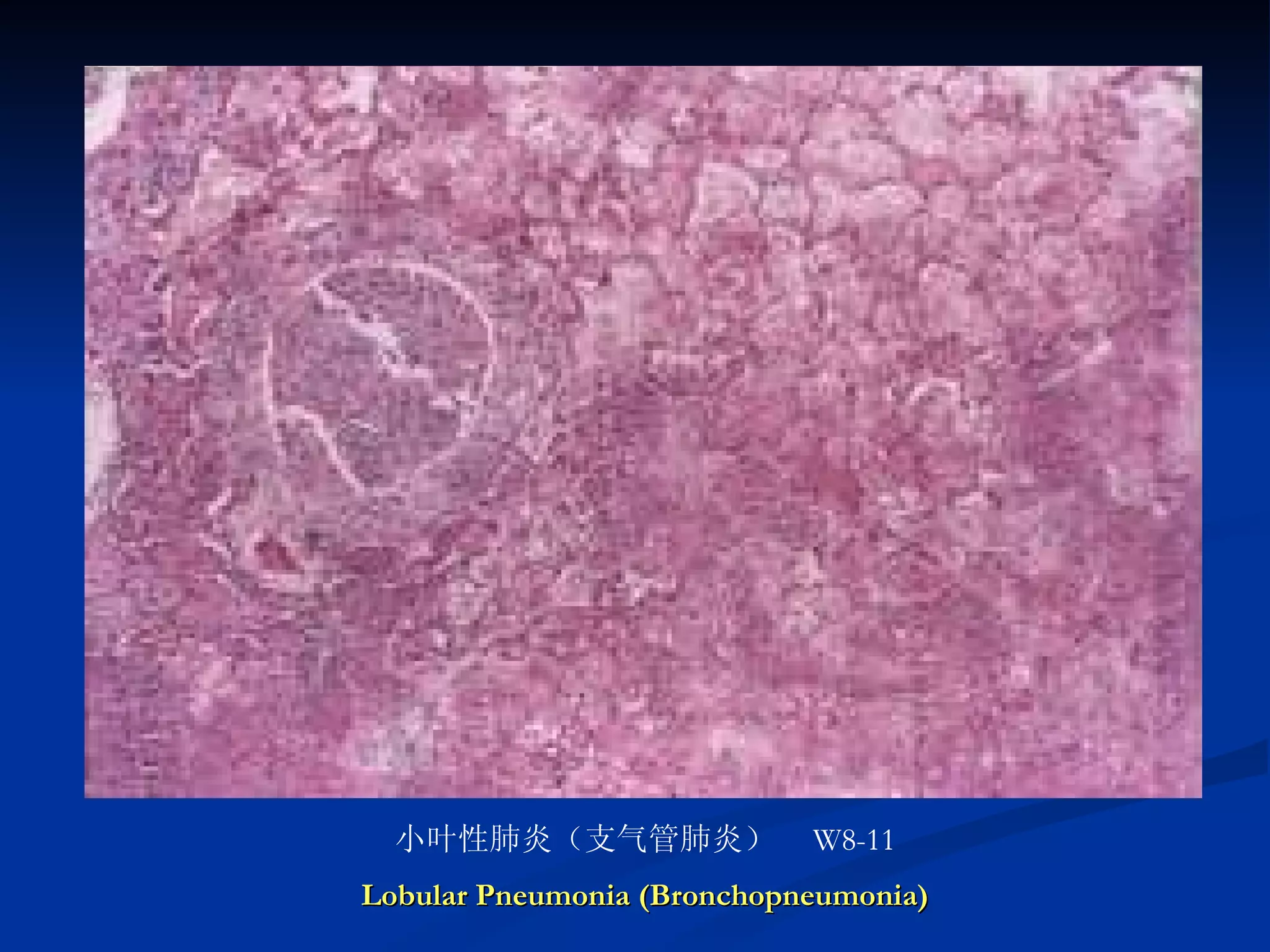 小叶性肺炎（支气管肺炎）　 W8-11 Lobular Pneumonia (Bronchopneumonia) 