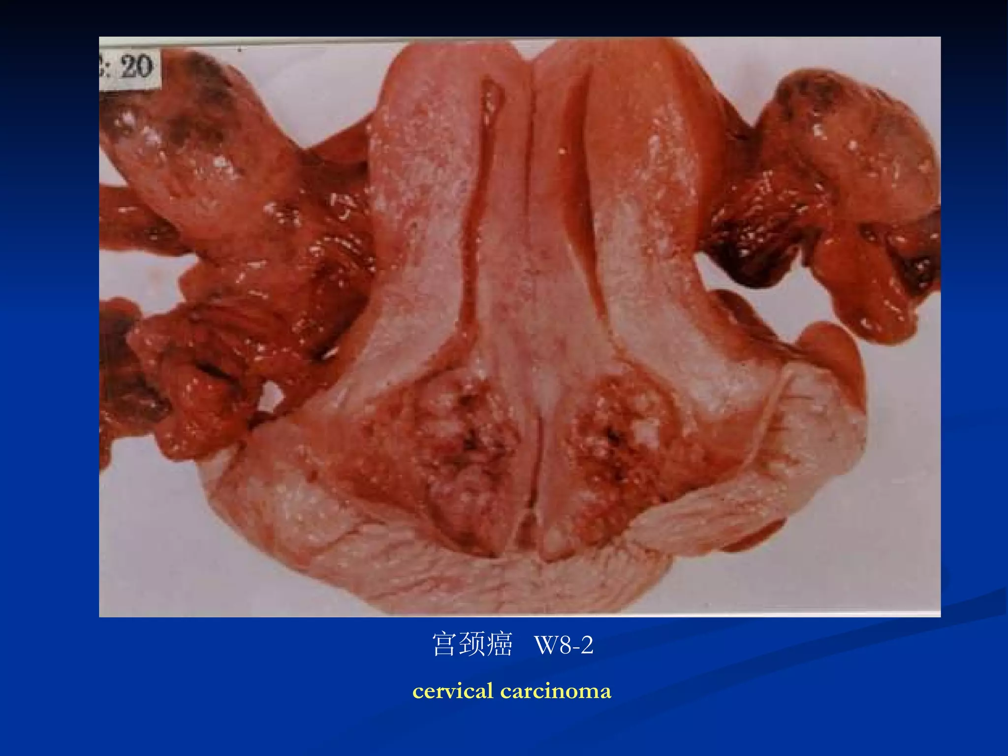 宫颈癌  W8-2 cervical carcinoma 