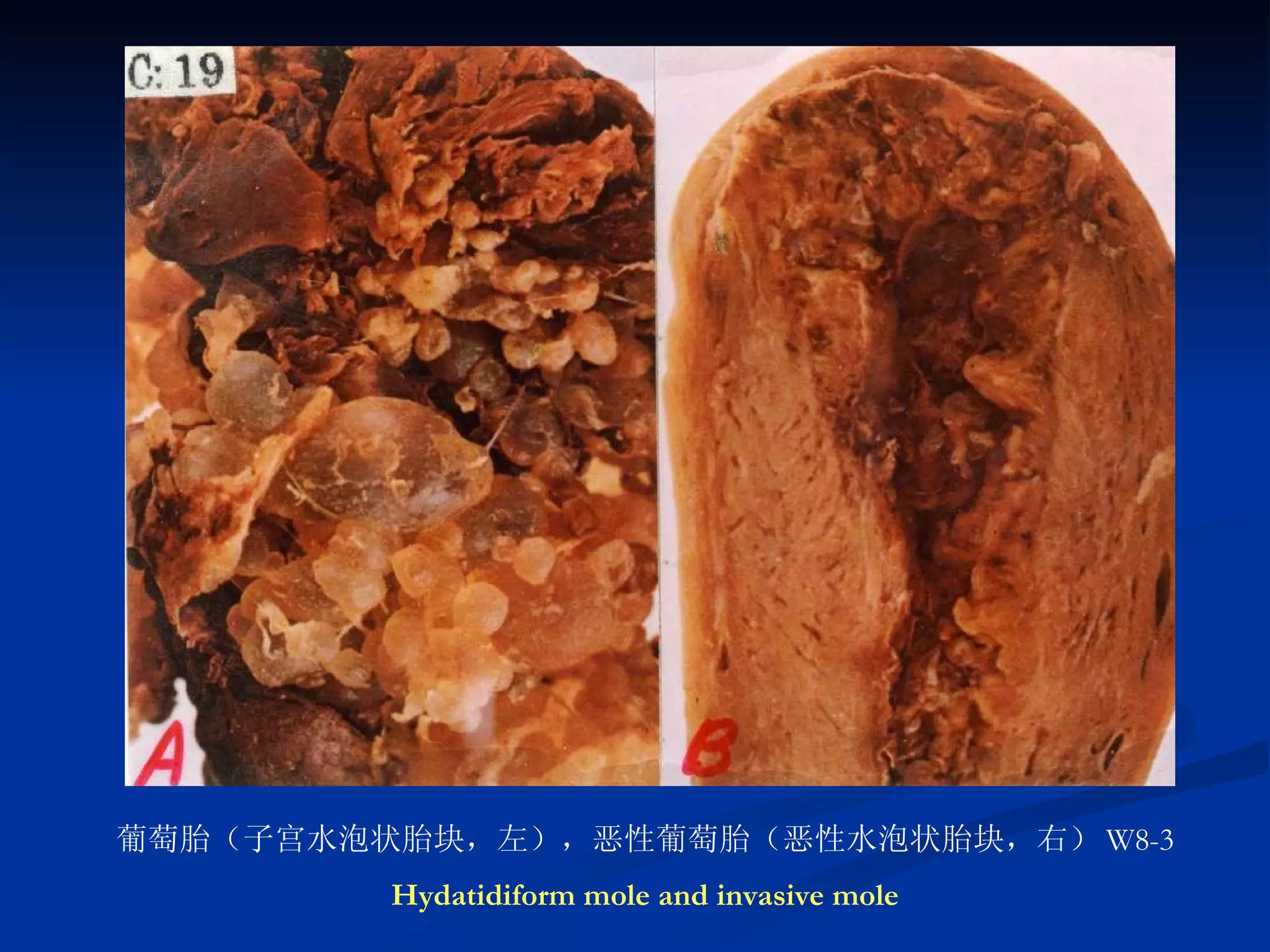 葡萄胎（子宫水泡状胎块，左），恶性葡萄胎（恶性水泡状胎块，右） W8-3 Hydatidiform mole and invasive mole 