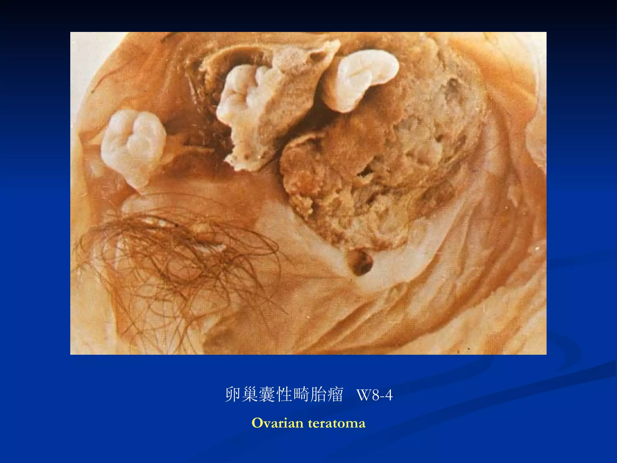 卵巢囊性畸胎瘤  W8-4 Ovarian teratoma 