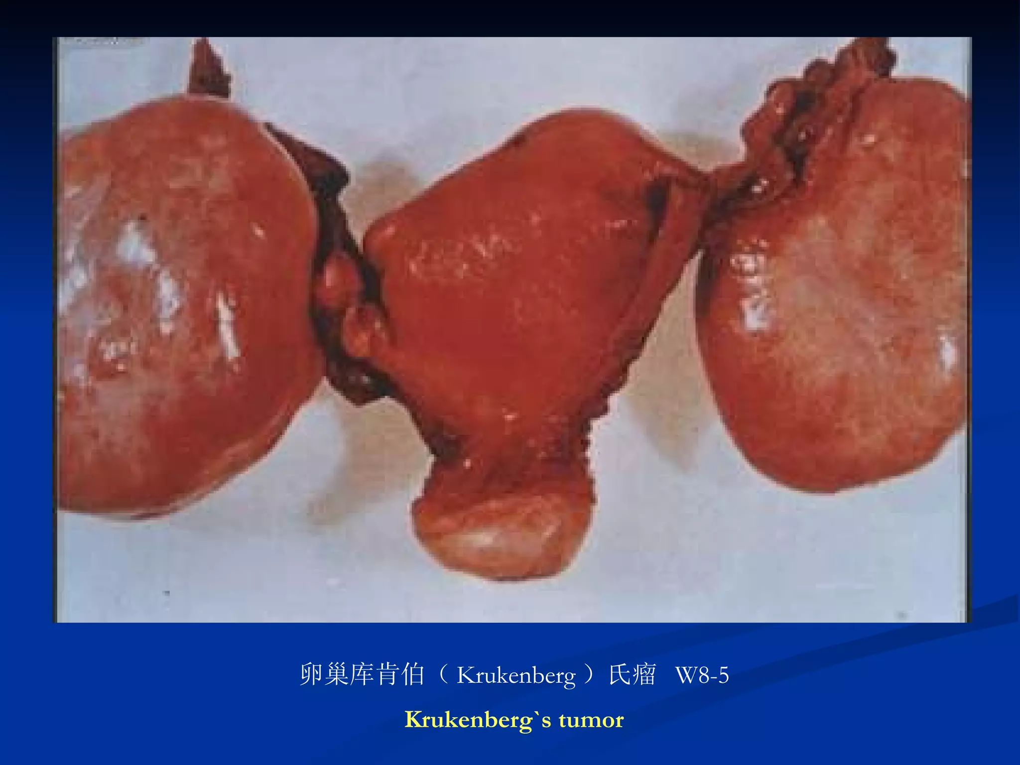 卵巢库肯伯（ Krukenberg ）氏瘤  W8-5 Krukenberg`s tumor 