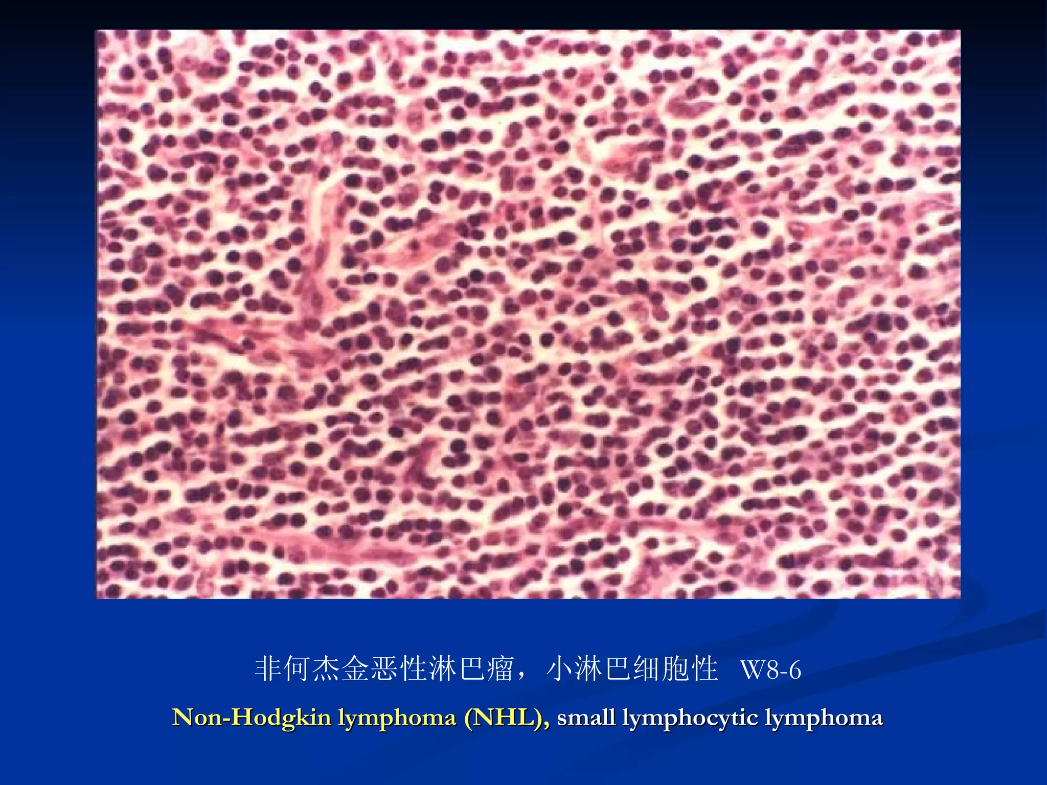 非何杰金恶性淋巴瘤，小淋巴细胞性  W8-6 Non-Hodgkin lymphoma (NHL),   small lymphocytic lymphoma 