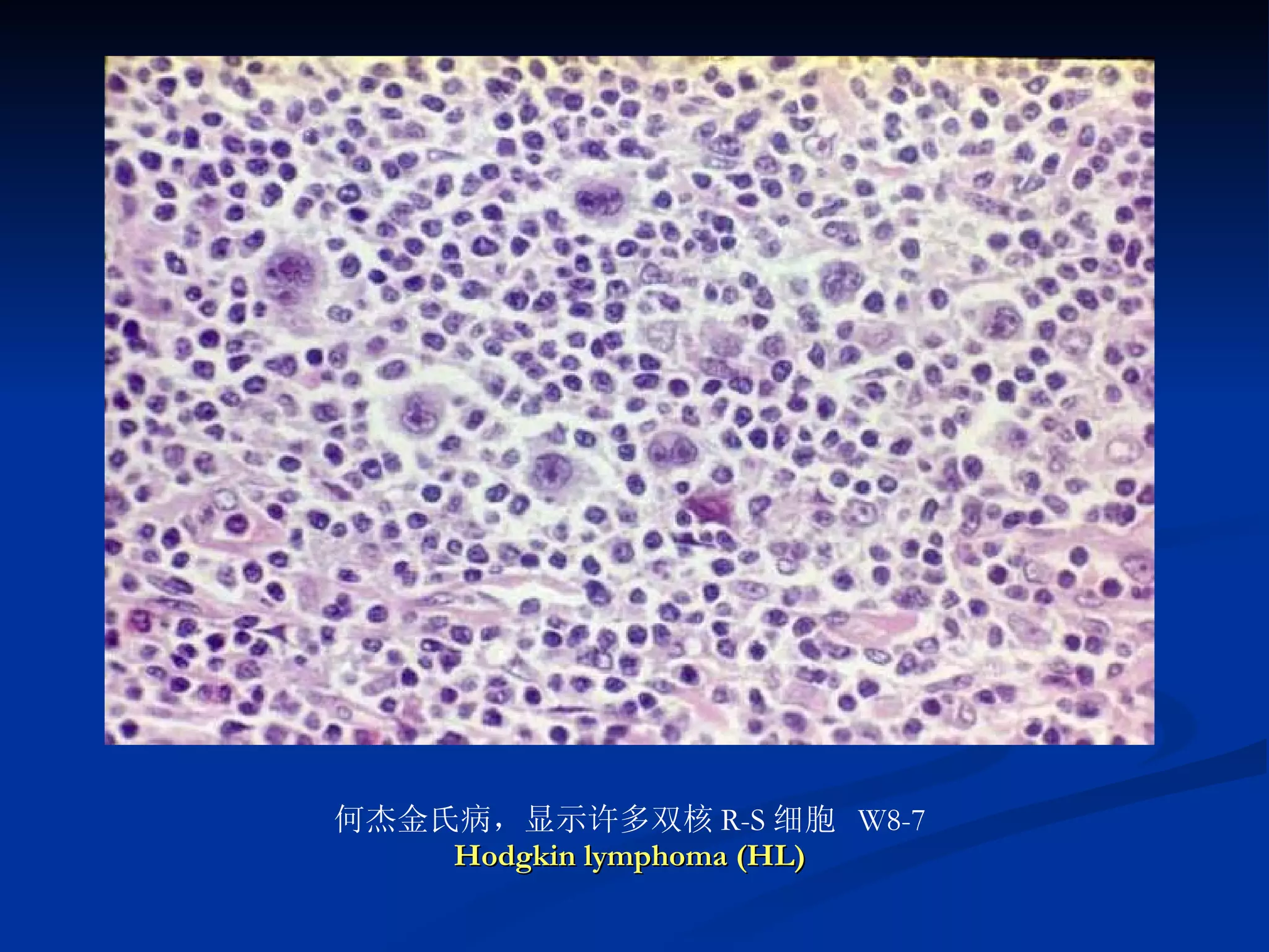 何杰金氏病，显示许多双核 R-S 细胞  W8-7 Hodgkin lymphoma (HL) 