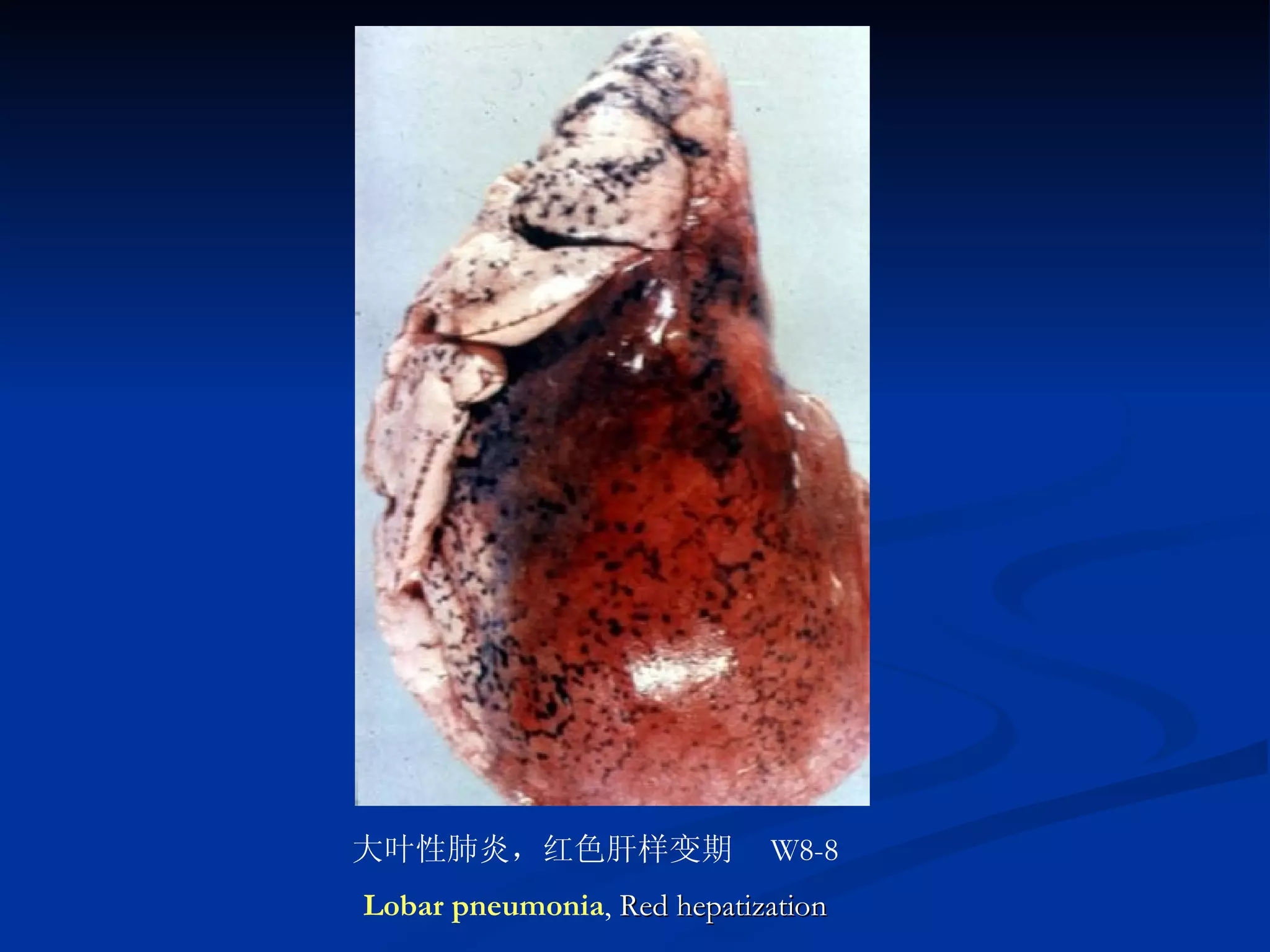 大叶性肺炎，红色肝样变期　 W8-8 Lobar pneumonia ,  Red hepatization 