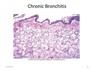 Chronic Bronchitis
10/24/2023 18
 