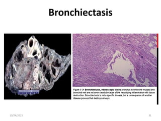Bronchiectasis
10/24/2023 31
 