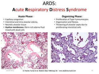 ARDS:
Acute Respiratory Distress Syndrome
Acute Phase:
• Capillary congestion
• Interstitial and intra-alveolar edema,
• Necrotic alveolar tissue
• Hyaline membranes: fibrin-rich edema fluid
mixed with dead cells
Organizing Phase:
• Proliferation of Type II pneumocytes
• Organization and fibrosis
• Thickening of alveolar septa due to
proliferating interstitial cells
10/24/2023 35
 
