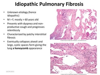 Idiopathic Pulmonary Fibrosis
• Unknown etiology (hence
idiopathic)
• M > F, mostly > 60 years old
• Presents with dyspnea and non-
productive cough and progresses
relentlessly
• Characterized by patchy interstitial
fibrosis
• Eventually collapses alveoli and
large, cystic spaces form giving the
lung a honeycomb appearance
10/24/2023 37
 