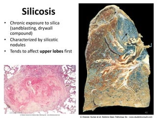 Silicosis
• Chronic exposure to silica
(sandblasting, drywall
compound)
• Characterized by silicotic
nodules
• Tends to affect upper lobes first
10/24/2023 40
 