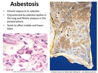 Asbestosis
• Chronic exposure to asbestos
• Characterized by asbestos bodies in
the lung and fibrotic plaques in the
parietal pleura
• Tends to affect middle and lower
lobes
10/24/2023 41
 