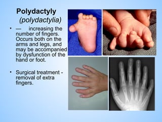 Excess Fingers Comprehensive Overview of Congenital Anomalies and Malformations in ...