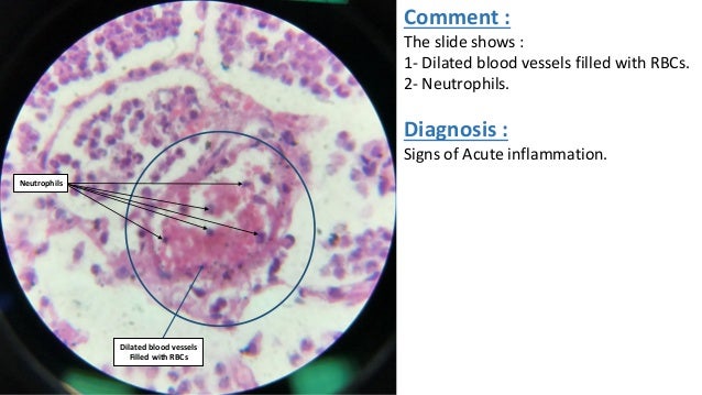 Pathology (acute inflammation)