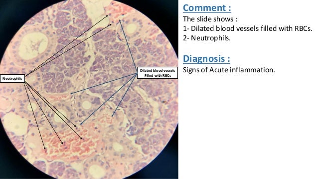 Pathology (acute inflammation)