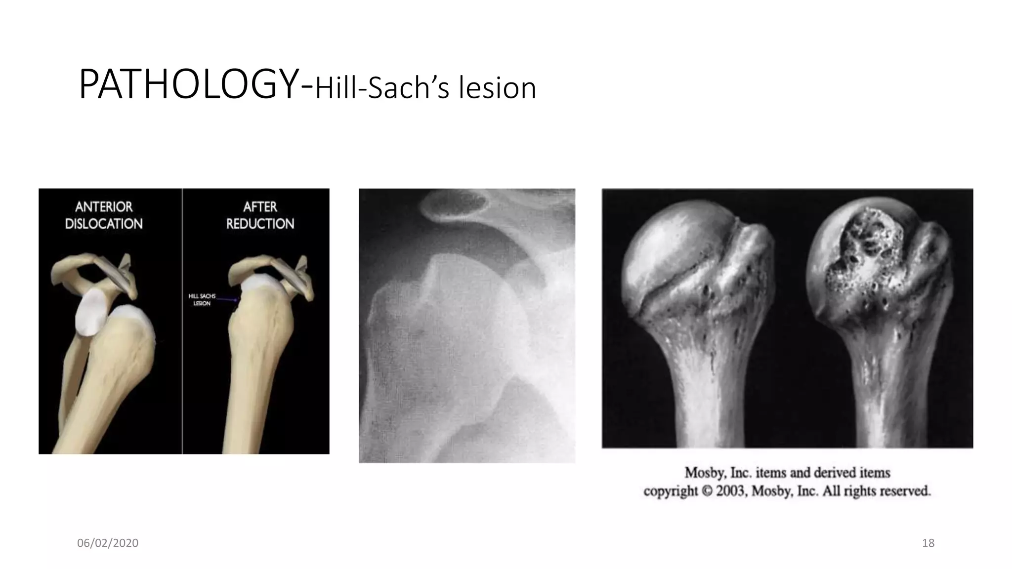 PATHOLOGY-Hill-Sach’s lesion
06/02/2020 18
 