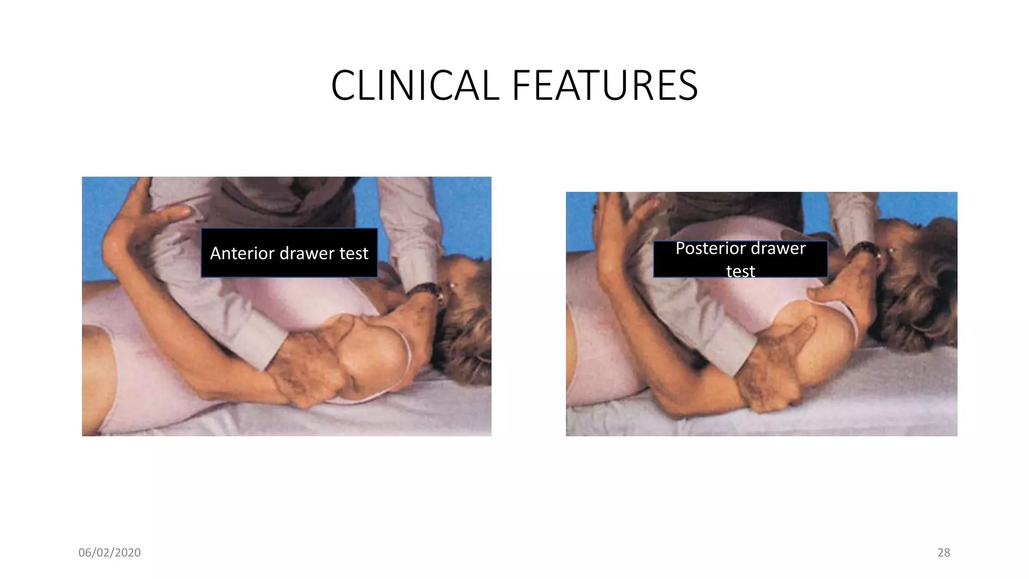CLINICAL FEATURES
Anterior drawer test Posterior drawer
test
06/02/2020 28
 