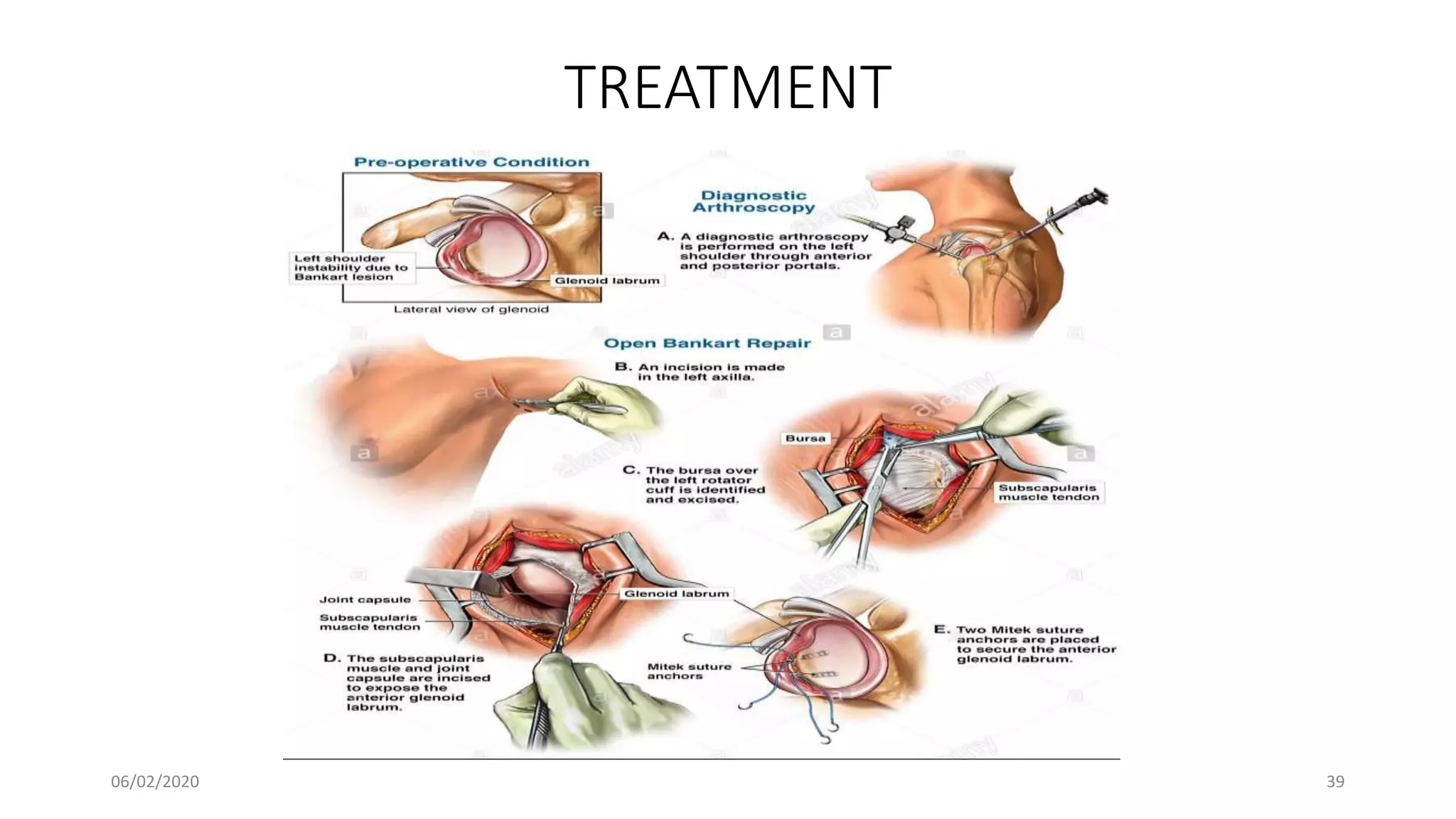 TREATMENT
06/02/2020 39
 