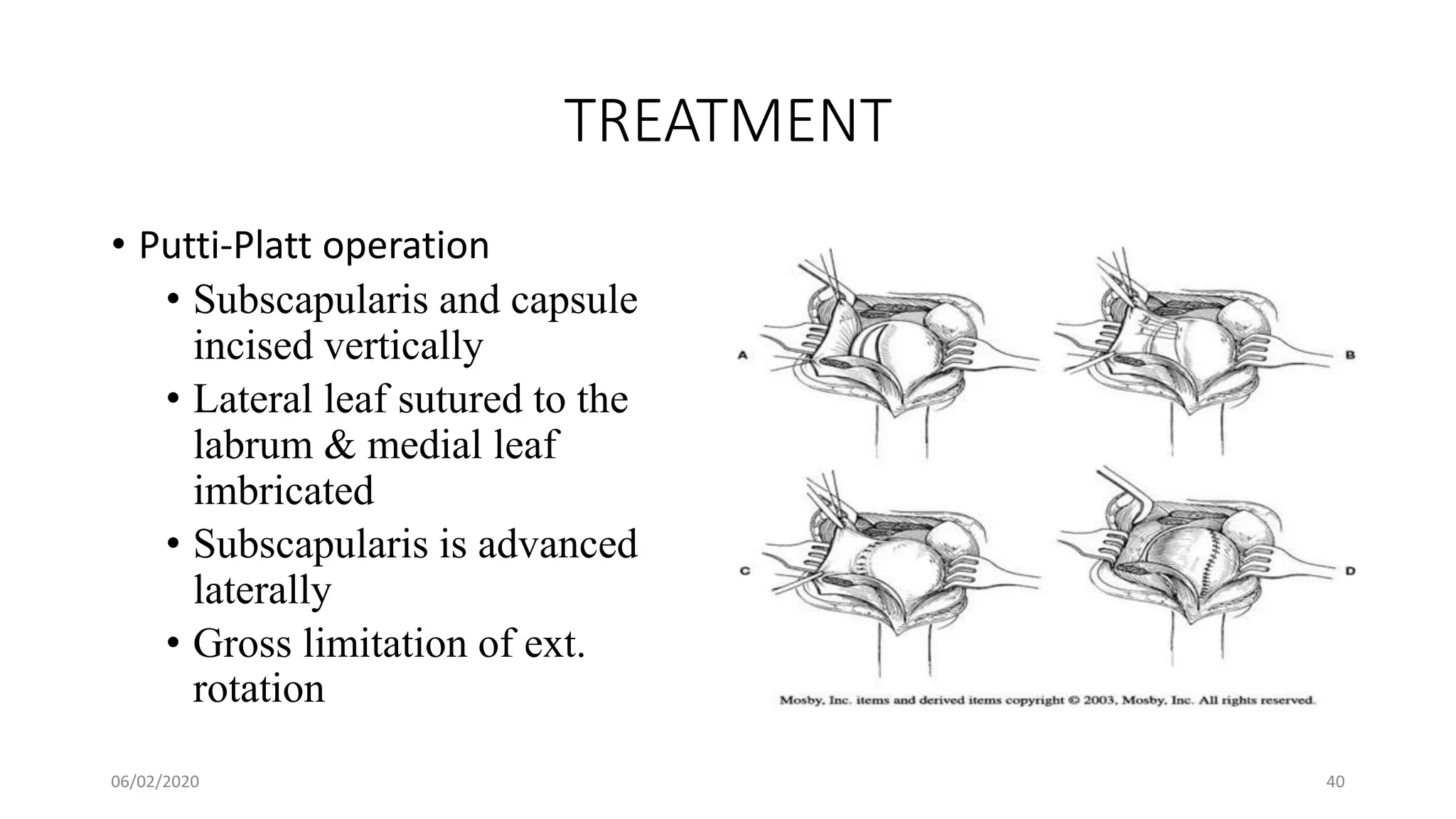 TREATMENT
• Putti-Platt operation
• Subscapularis and capsule
incised vertically
• Lateral leaf sutured to the
labrum & medial leaf
imbricated
• Subscapularis is advanced
laterally
• Gross limitation of ext.
rotation
06/02/2020 40
 